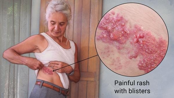 Superfoods that Battle the Herpes Virus - L & L Supplement LLC